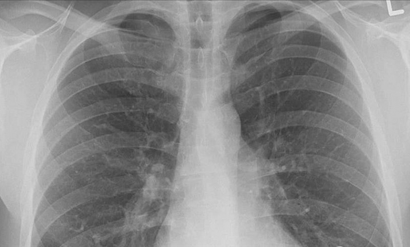 Pasif içicilerde 'akciğer kanseri' riski yüzde 30 artıyor